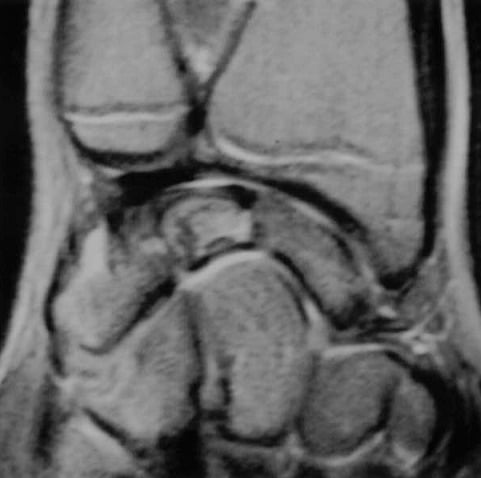 Coronal MRI of the lunate with new internal signal suggesting early revascularisation