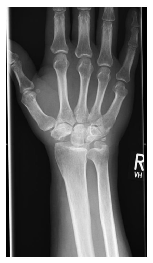 Frontal radiograph after proximal row carpectomy, the capitate articulating with the radius