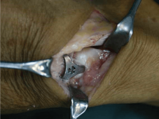 Intraoperative view of the Ni–Ti memory alloy concentrator after insertion into the scaphoid, trapezium, and trapezoid.