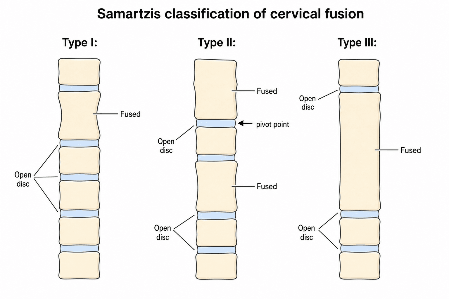 Schematic of the Samartzis classification: Type I single block vertebra, Type II two non-contiguous fused blocks with an open intercalated pivot segment, Type III a long contiguous multi-level fused block.