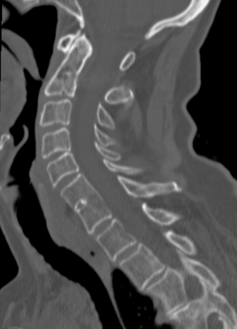 Sagittal CT reconstruction of the cervical spine showing a congenital C6-C7 block vertebra with absent disc space and a wasp-waist contour.