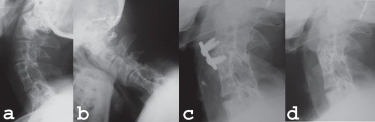 Serial lateral cervical radiographs showing two fused blocks, motion at the intervening C4-C5 segment, fixation and later implant removal