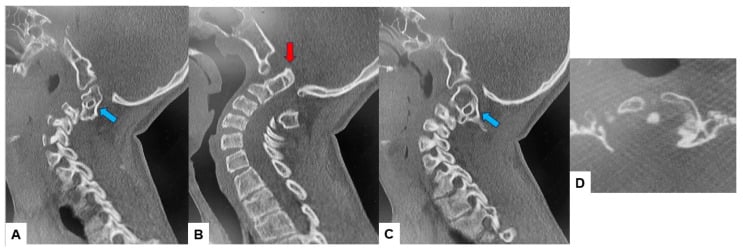Multiplanar cervical CT showing basilar invagination, C2-C3 fusion and craniovertebral junction anatomy