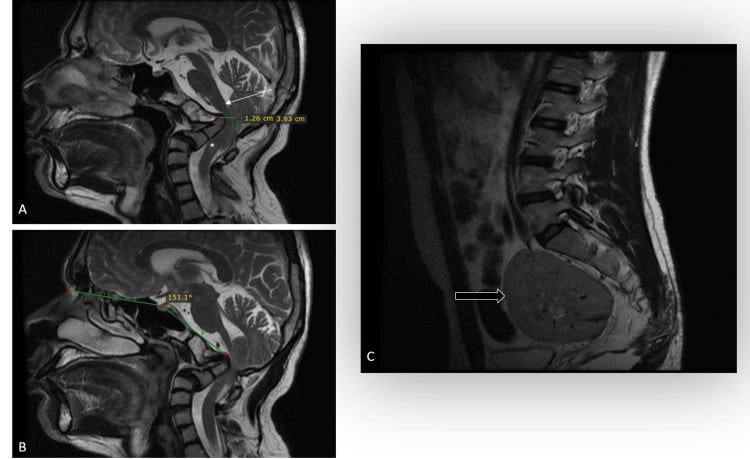 Sagittal and axial cervical MRI showing Chiari I malformation, basilar invagination and upper cervical myelomalacia