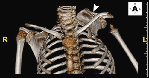 3D CT reconstruction of the cervicothoracic skeleton in Klippel-Feil syndrome with Sprengel's deformity
