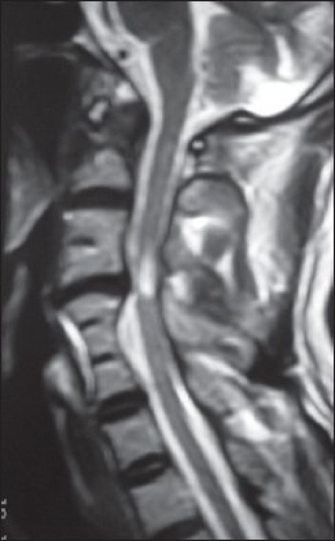 Sagittal T2 cervical MRI showing C4-C5 disc prolapse, dural compression and spinal cord hyperintensity between fused blocks