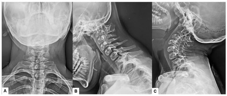 AP and flexion-extension cervical radiographs showing C2-C3 fusion and superior odontoid migration in Klippel-Feil syndrome