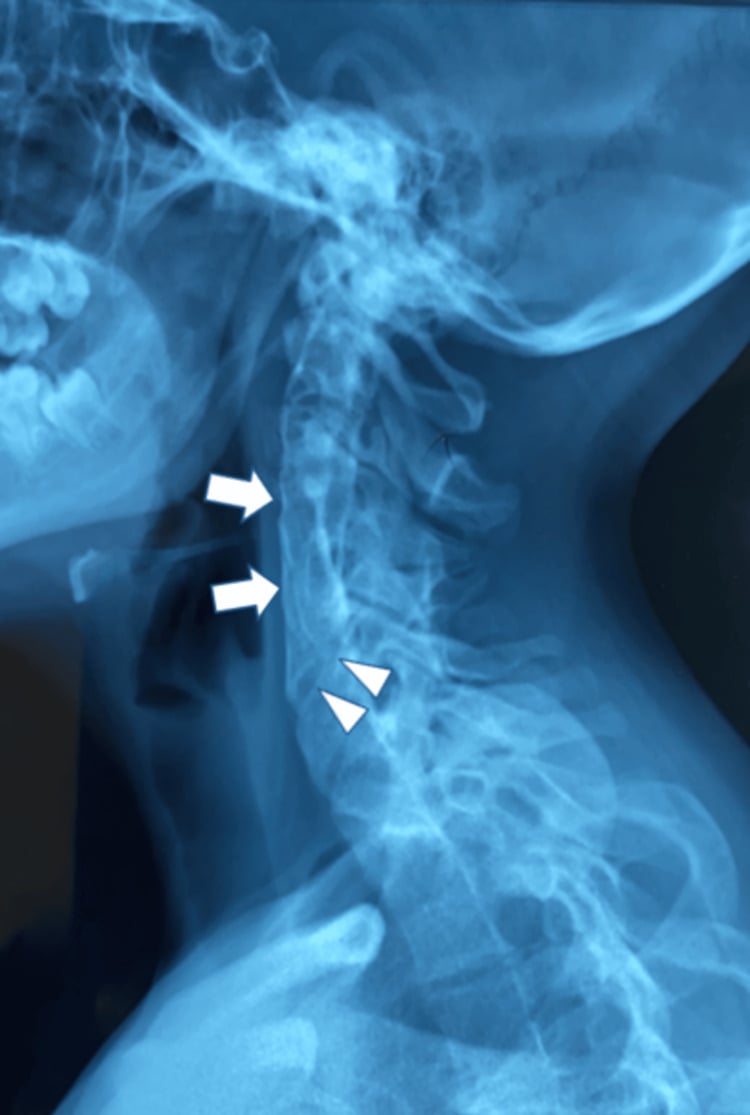 Lateral cervical radiograph showing contiguous C3-C5 fusion with partial posterior C5-C6 fusion in Klippel-Feil syndrome