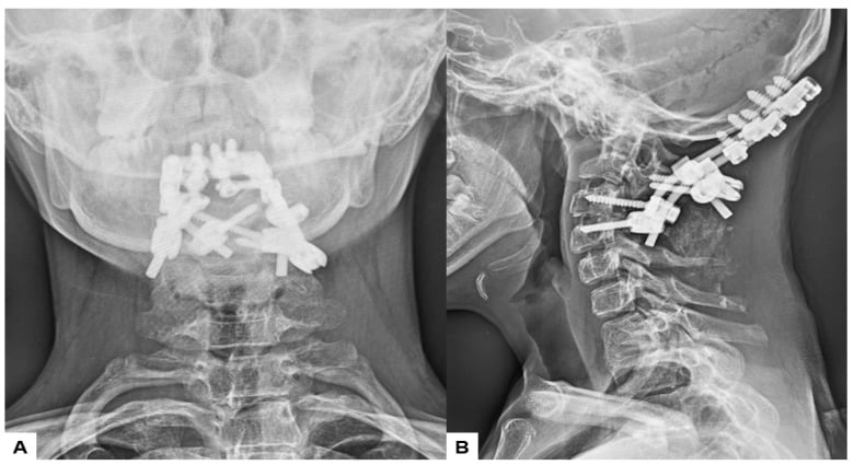 AP and lateral postoperative radiographs showing occipitocervical fusion instrumentation for basilar invagination in Klippel-Feil syndrome