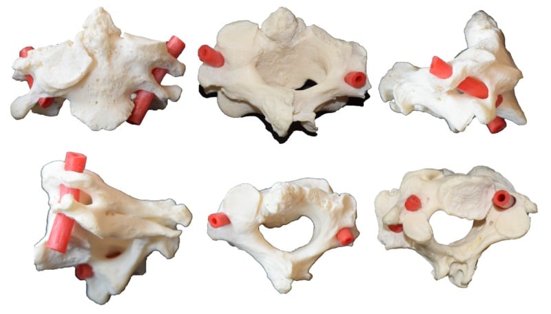 Six-view 3D CT angiographic reconstruction showing anomalous V2 vertebral artery courses in Klippel-Feil syndrome