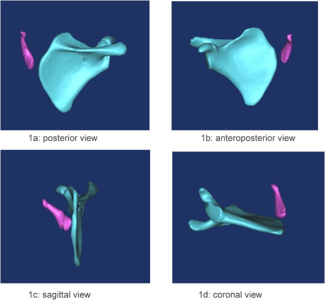 Four-view 3D CT reconstructions showing the scapula and omovertebral bone in Sprengel deformity