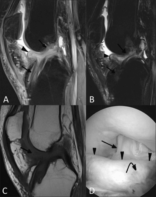 Four-panel MRI and arthroscopic figure of a cyclops lesion after ACL reconstruction