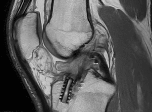 Sagittal MRI after ACL reconstruction showing a cyclops nodule anterior to the graft