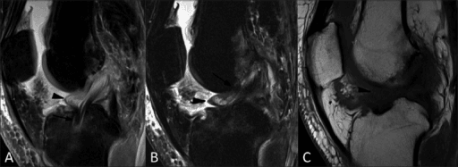Three-panel sagittal MRI of a cyclops lesion anterior to an ACL graft