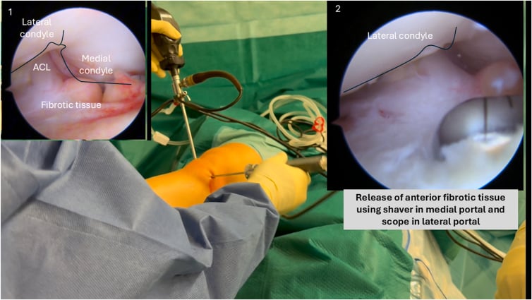 Arthroscopic resection of anterior knee fibrotic tissue with a motorised shaver