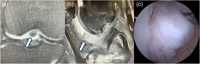 Coronal and sagittal MRI with arthroscopic view of a cyclops lesion after ACL reconstruction