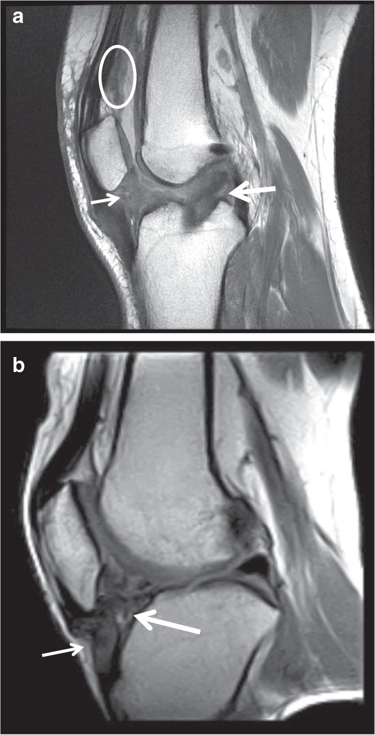 Sagittal MRI showing diffuse scar around an ACL graft, infrapatellar fat pad and suprapatellar recess