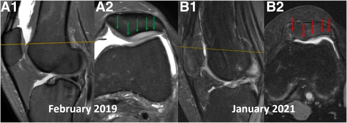 Serial sagittal and axial knee MRI showing rapid patellofemoral cartilage damage during forceful rehabilitation