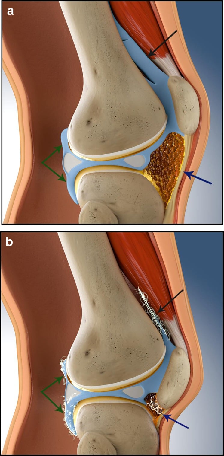 Cross-sectional diagrams comparing a healthy knee with generalised arthrofibrosis