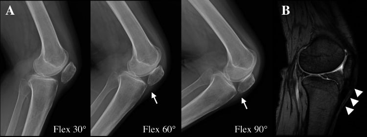 Dynamic lateral radiographs and MRI showing patella baja with a thickened patellar tendon