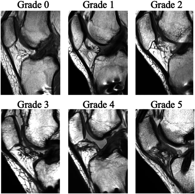 Sagittal proton-density MRI examples grading infrapatellar fat-pad fibrosis from focal to diffuse