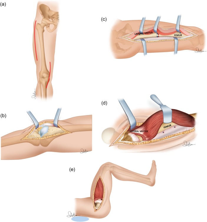 Illustrated sequential stages of Judet quadricepsplasty for severe knee stiffness