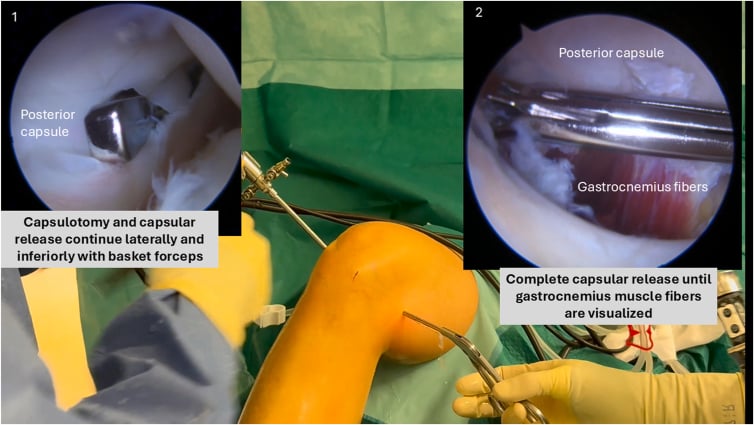 Arthroscopic posteromedial capsular release using basket forceps