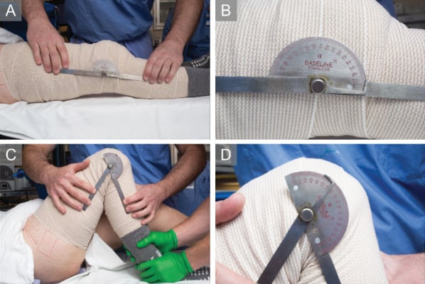 Clinical measurement of knee extension and flexion with a goniometer after arthroscopic lysis of adhesions