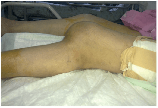 Clinical photograph of knee dislocation showing gross deformity