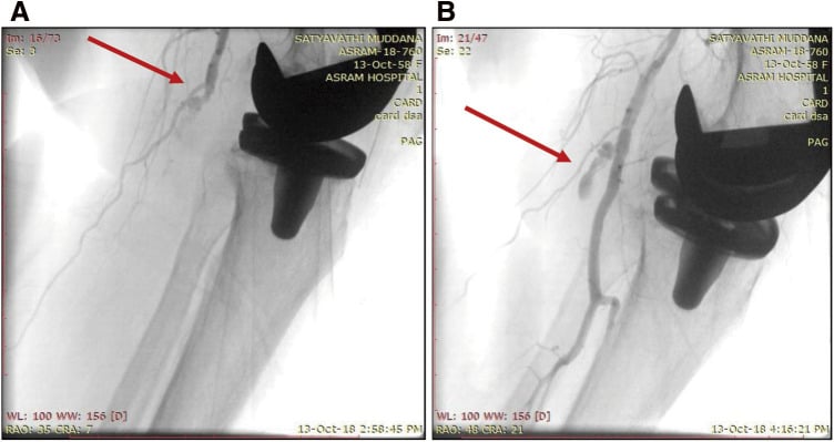 Conventional angiogram demonstrating popliteal artery occlusion in knee dislocation