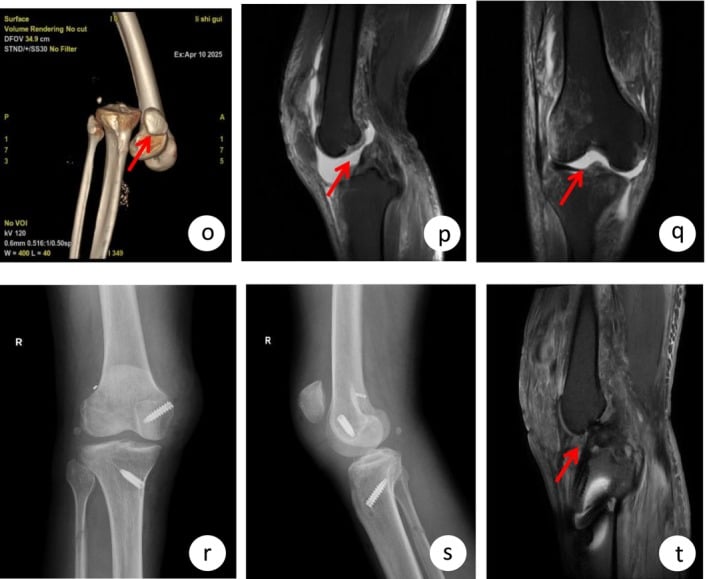 3D CT scan, lateral radiograph, and MRI of posterior knee dislocation