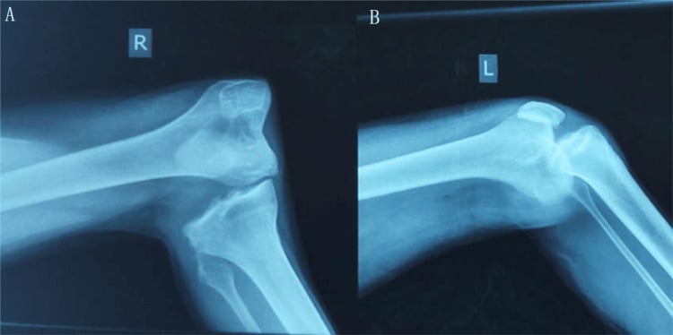 Bilateral lateral knee radiographs showing anterior and posterior knee dislocations