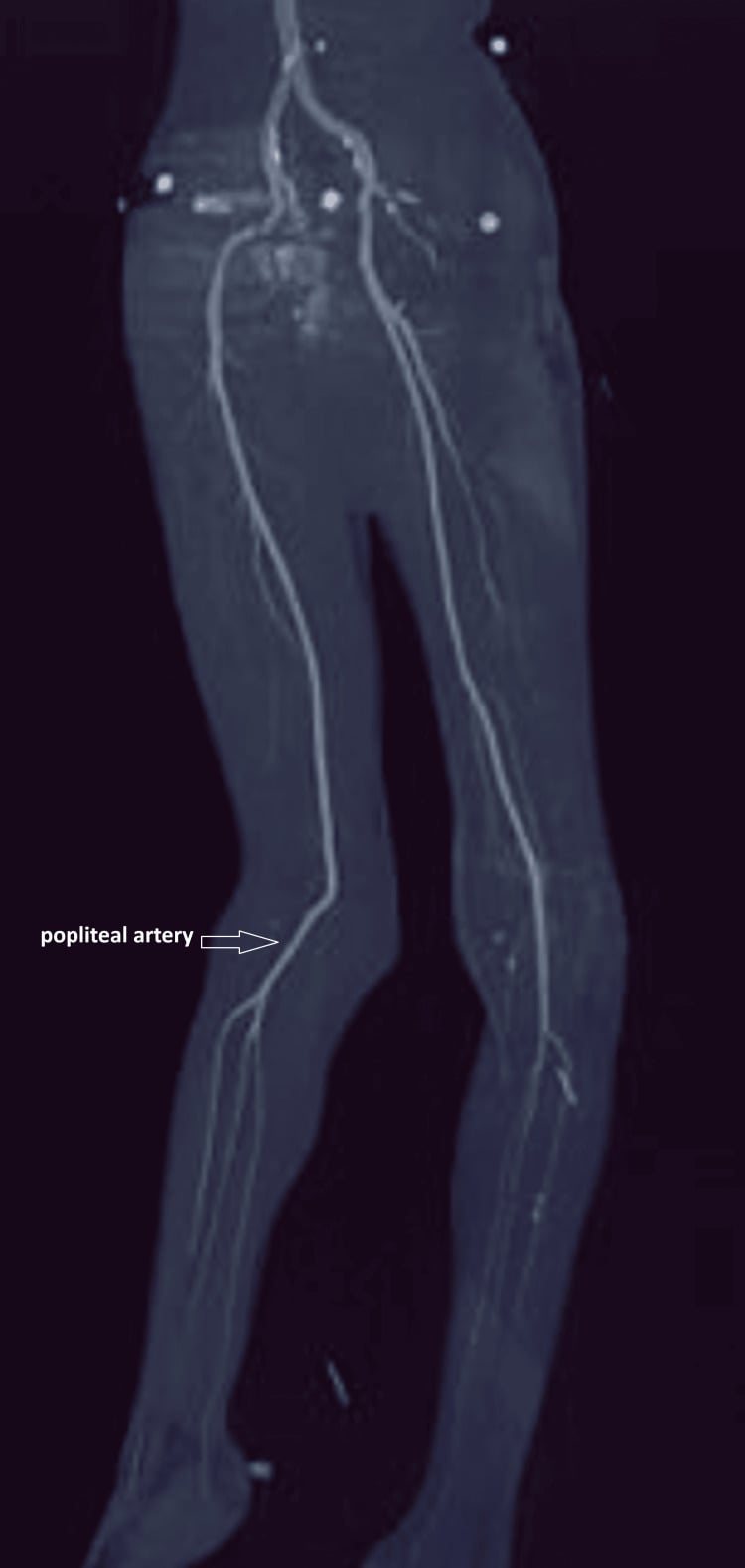 CT angiography 3D reconstruction evaluating popliteal artery patency