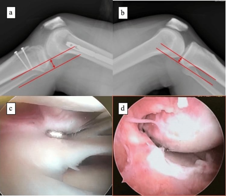 Radiographs and arthroscopic views of multiligament knee reconstruction