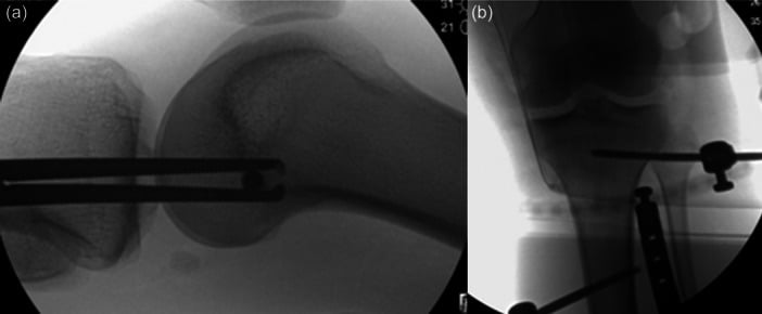 Intraoperative fluoroscopy demonstrating hinged external fixator pin placement