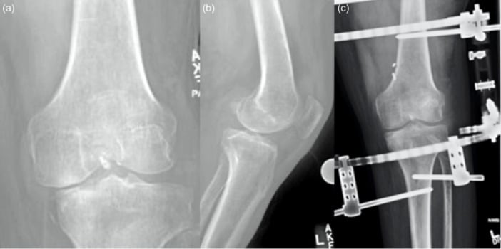 Preoperative and postoperative radiographs of knee dislocation joint-spanning external fixator