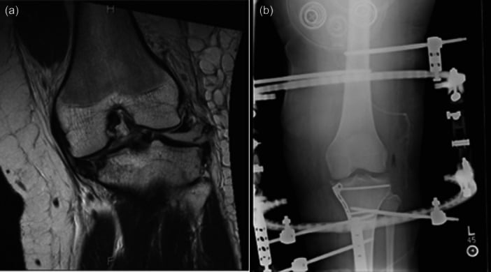 Coronal MRI and postoperative radiograph of joint-spanning external fixator