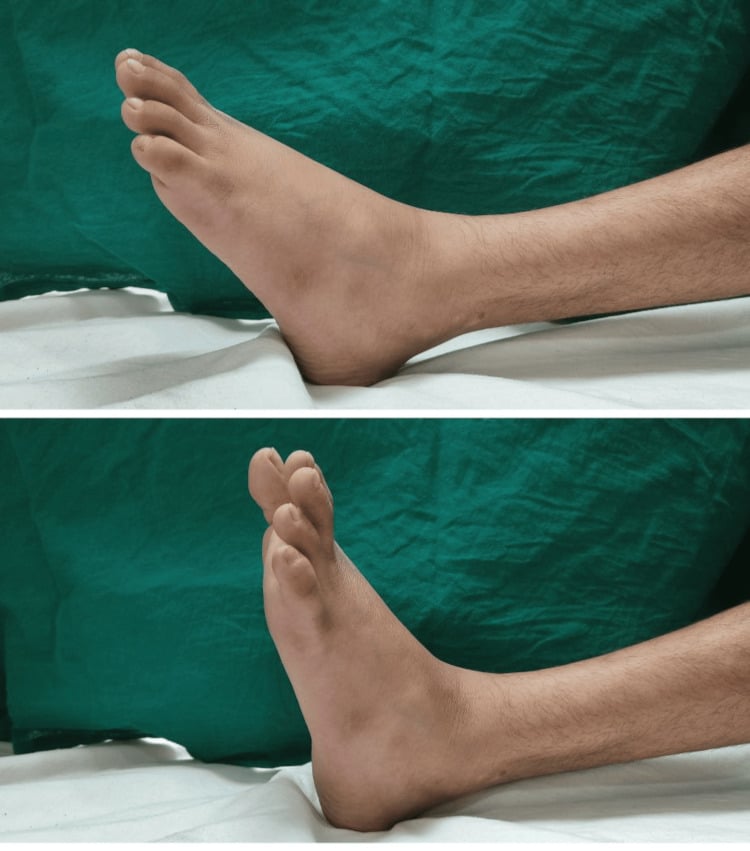 Clinical photograph demonstrating ankle dorsiflexion recovery after peroneal nerve release
