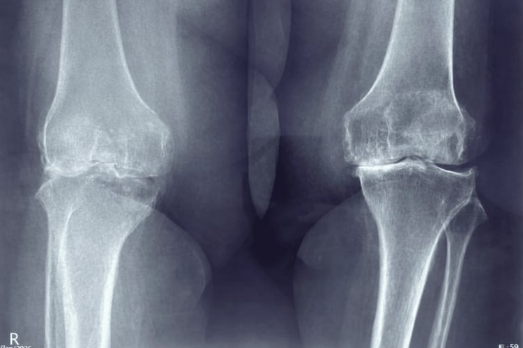 Anteroposterior radiograph of both knees with advanced osteoarthritis
