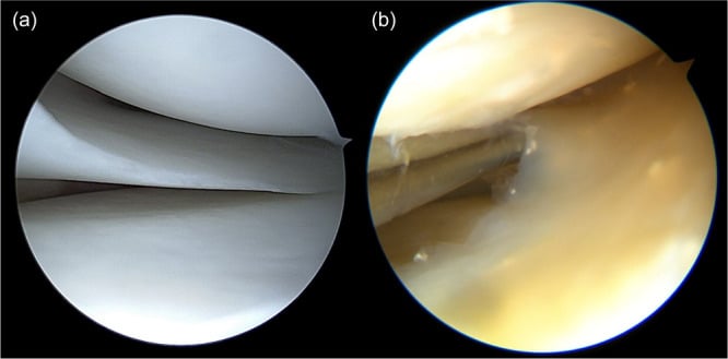 Arthroscopic comparison of healthy and degenerated meniscal tissue