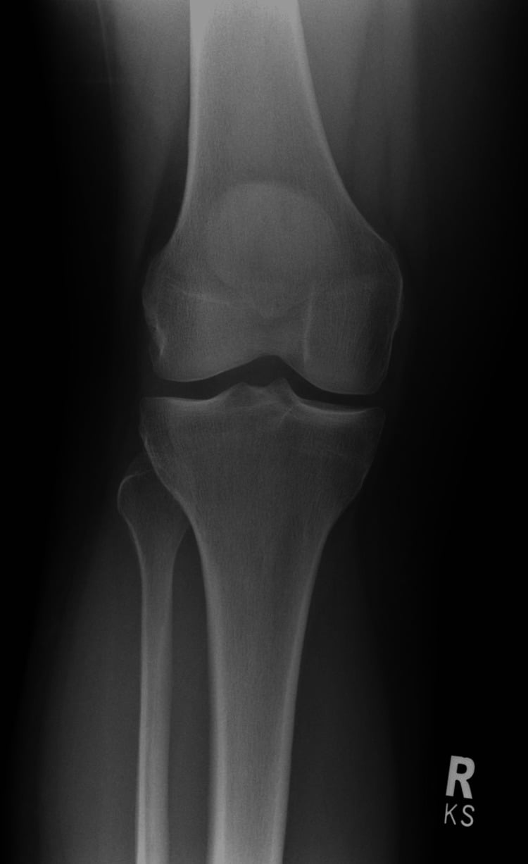 Anteroposterior knee radiograph showing Kellgren-Lawrence grade 0