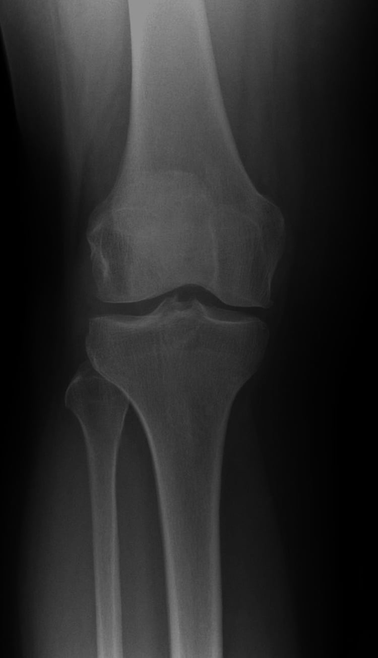Anteroposterior knee radiograph showing Kellgren-Lawrence grade 1