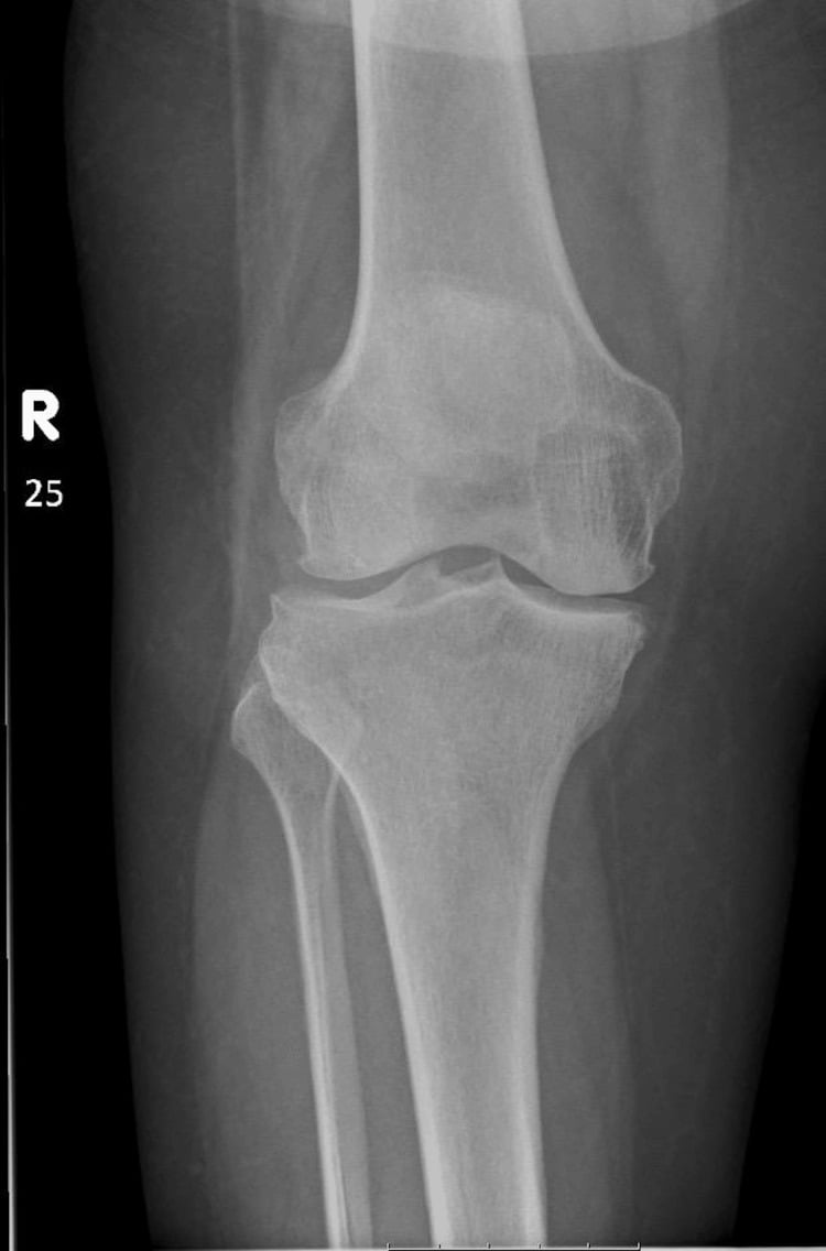 Anteroposterior knee radiograph showing Kellgren-Lawrence grade 3