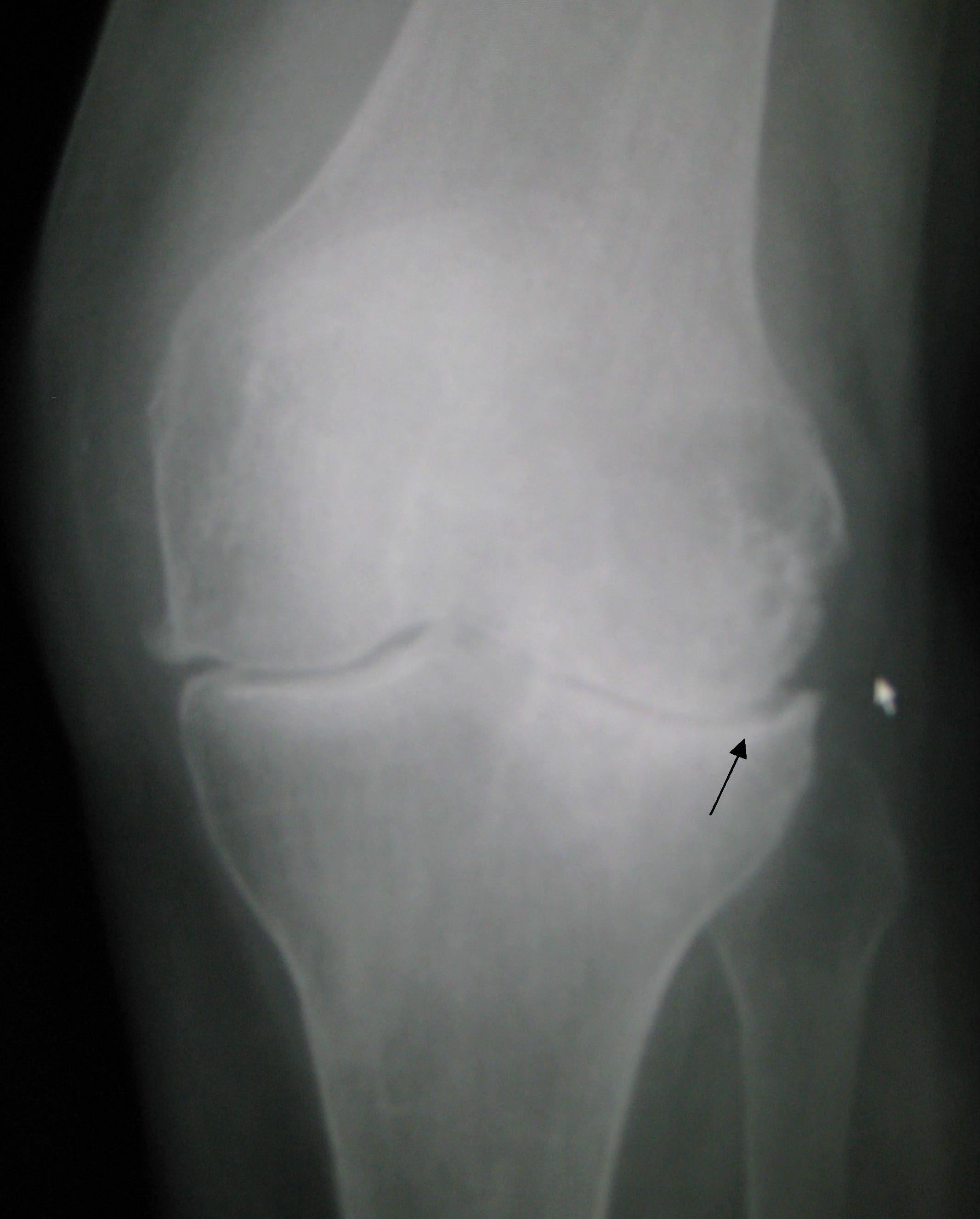 AP knee radiograph showing osteoarthritis with joint space narrowing and increased subchondral bone density