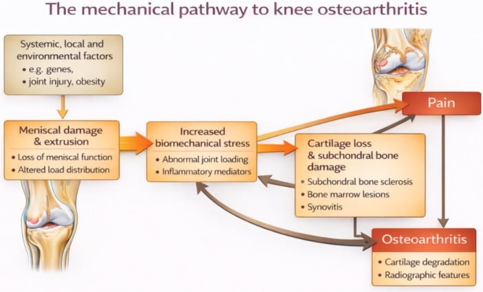 Mechanical pathway linking meniscal degeneration to knee osteoarthritis