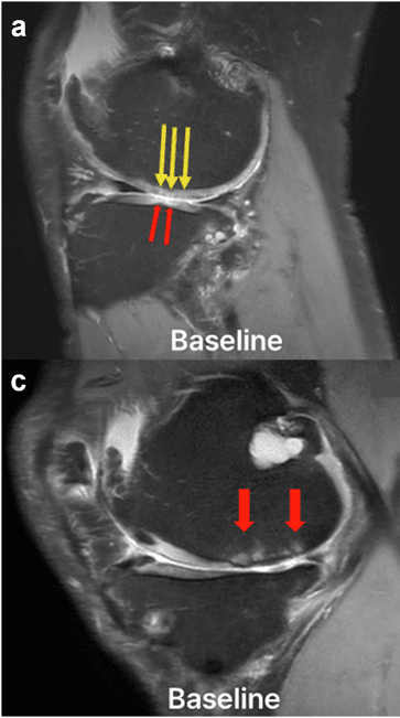 Sagittal knee MRI showing cartilage defects and subchondral bone changes in osteoarthritis