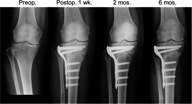 Serial radiographs before and after high tibial osteotomy