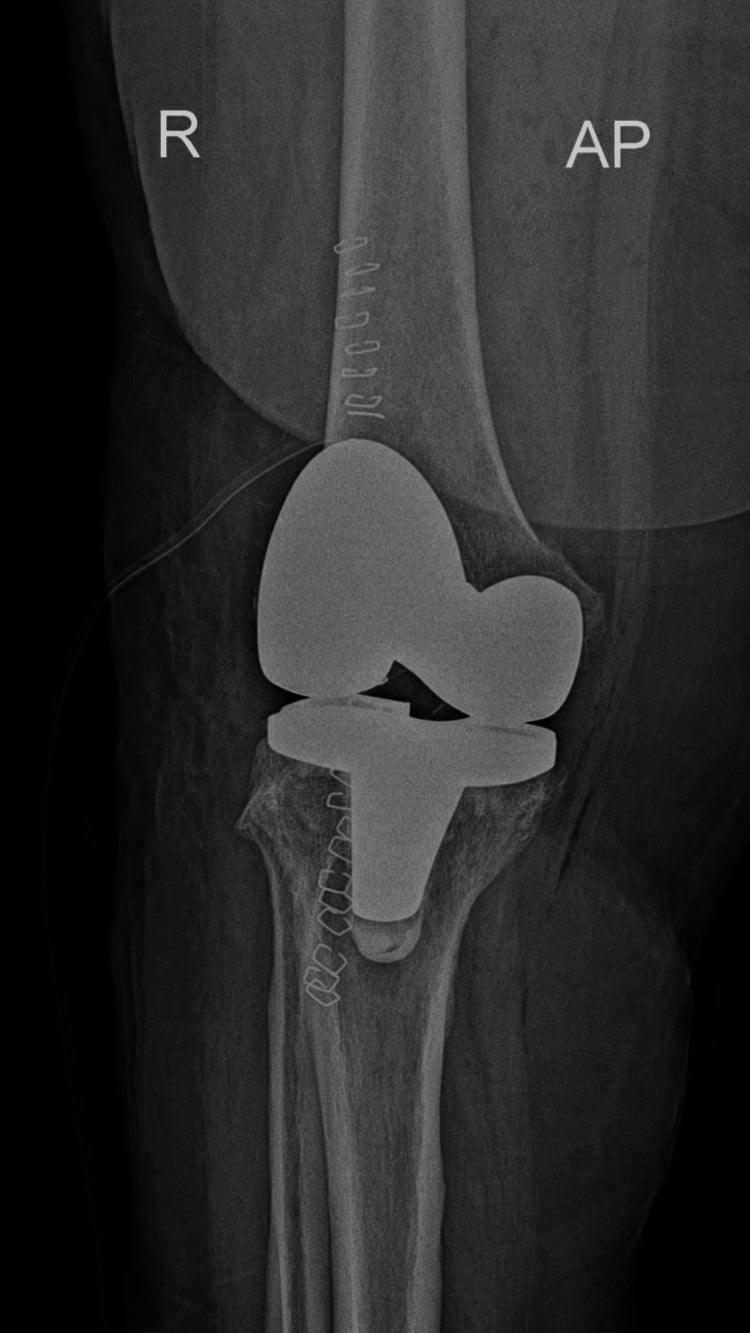 Postoperative anteroposterior radiograph of a total knee arthroplasty with skin staples in place