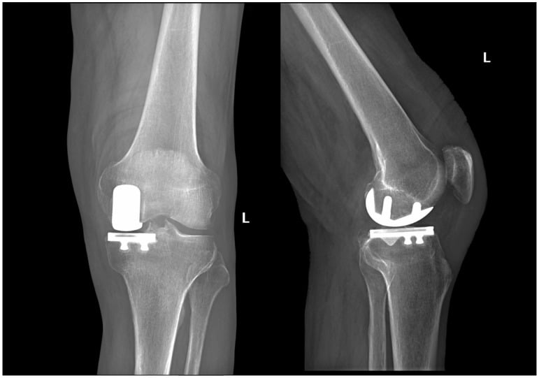 Postoperative anteroposterior and lateral radiographs of a medial unicompartmental knee arthroplasty