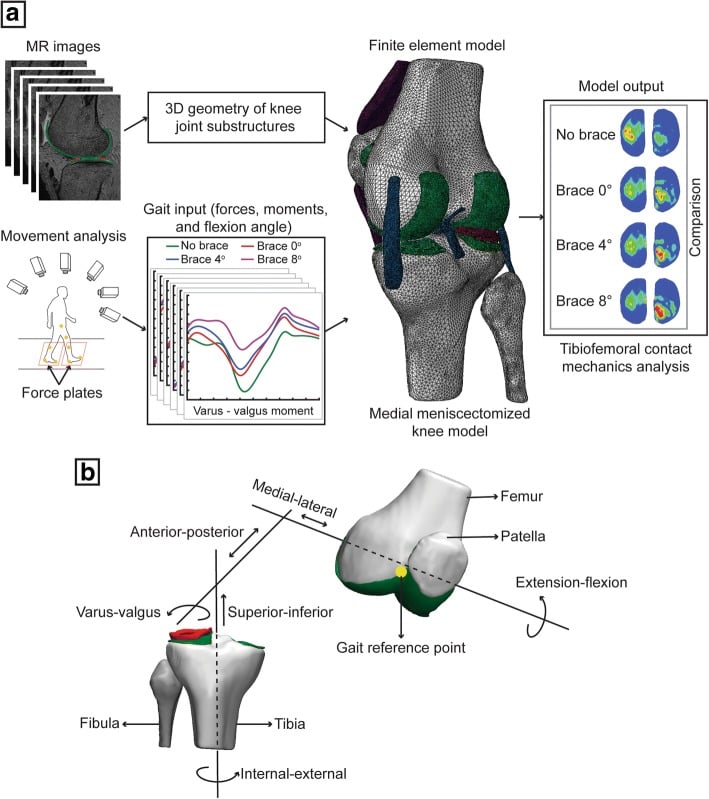 Biomechanical workflow modelling the effects of a valgus unloader knee brace